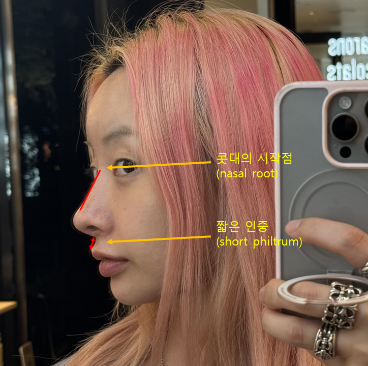 Rhinoplasty for Zainichi Koreans, Rhinoplasty for Japanese Koreans image 3