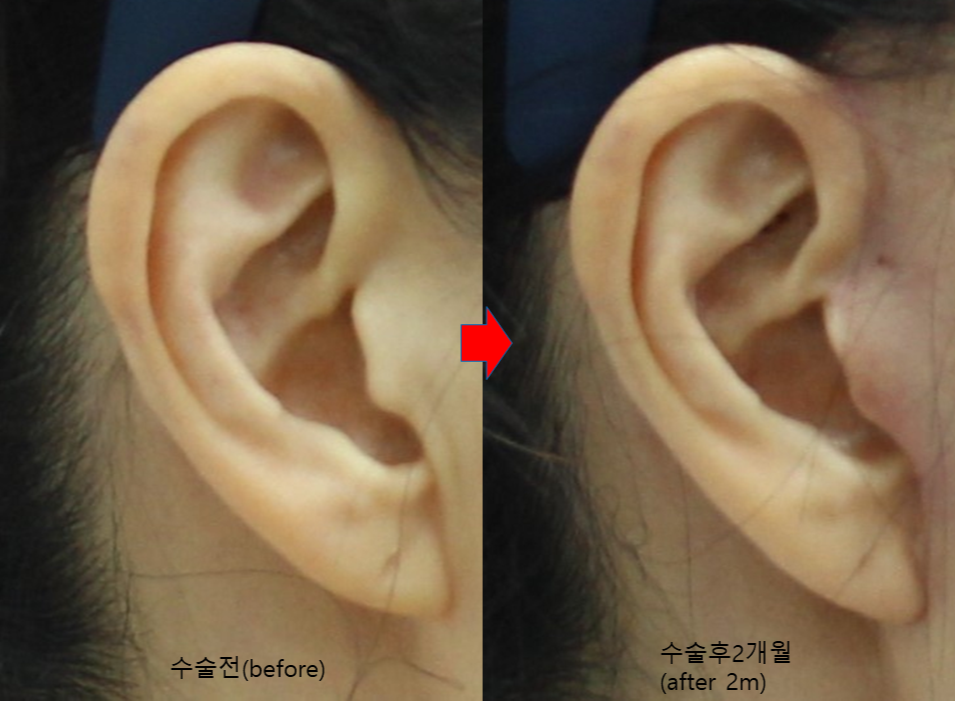 Changes in Incisions and Scars in Deep Mini Facelift image 6