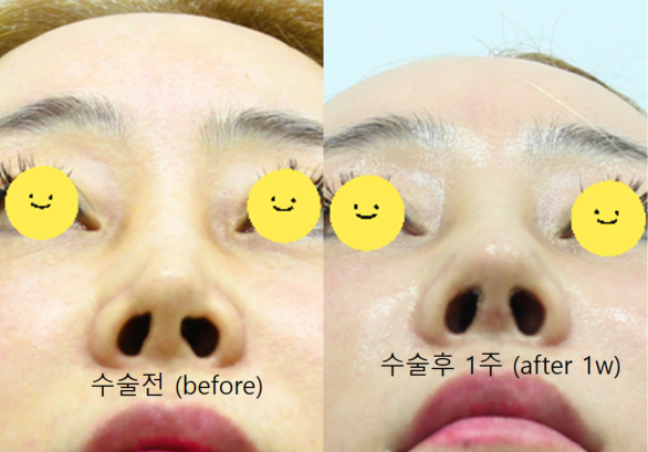 Correction of a Pinched Nose or Indented Nose image 9