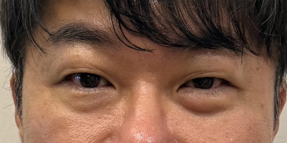직장인 상하안검 수술, 연휴를 이용해 회복할 수 있을까? 관련 이미지 1