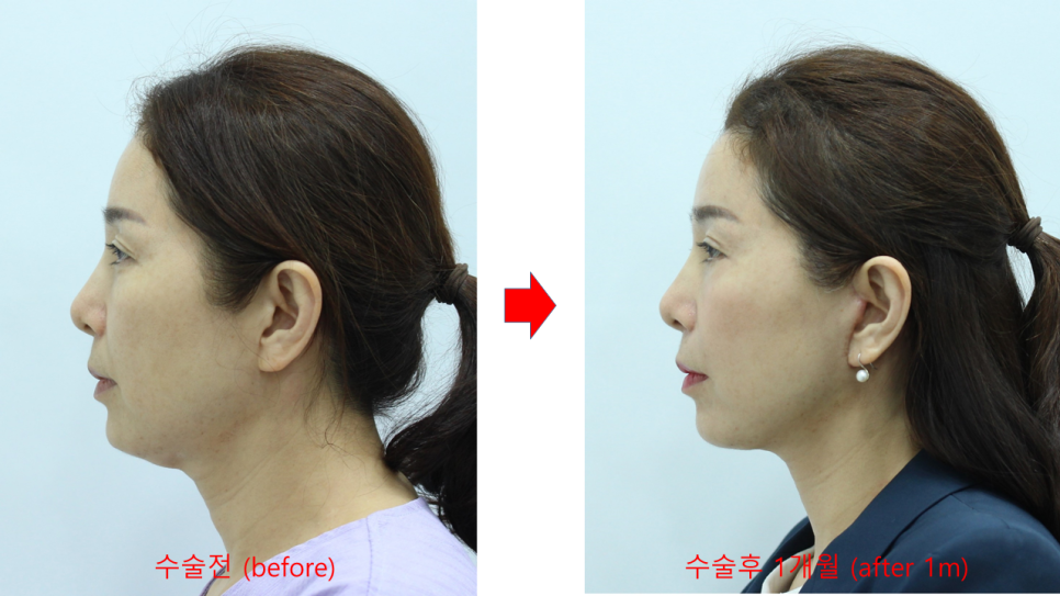 노화의 원인을 교정하는 중년성형 수술 관련 이미지 5