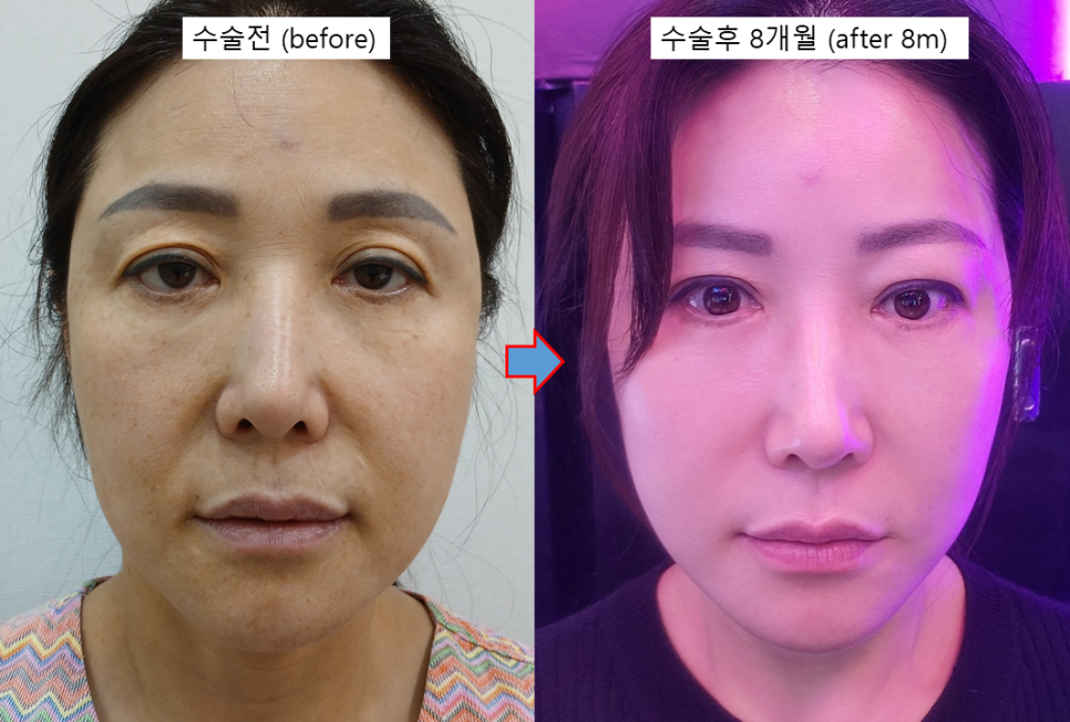 안면거상의 완성도를 높이는 펠리컨 수술 관련 이미지 3