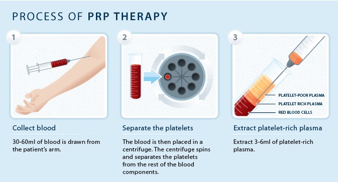 PRP Fat Grafting to Correct a Peanut-Shaped Face image 5