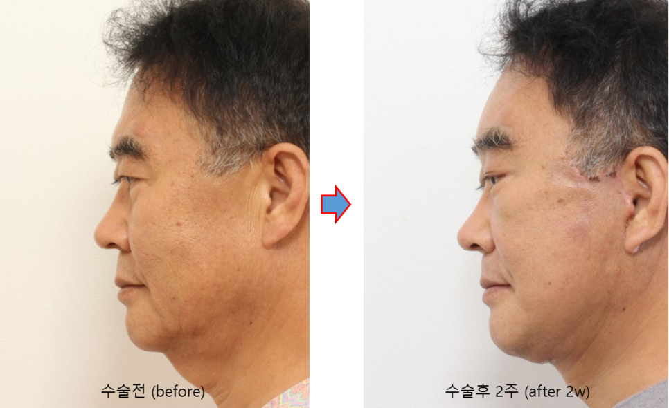 60대 남자 거상수술, 브래드 피트와 비슷한 나이의 실제 수술 사례 관련 이미지 9