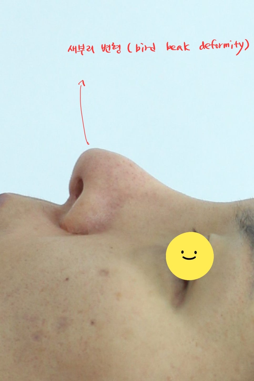 Rib Cartilage Nose Revision Surgery for Bird Beak Deformity image 1