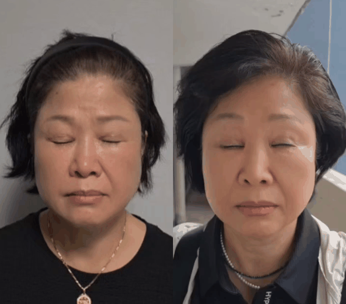 쌍꺼풀 재수술, 함몰흉터는 개선되고 눈은 편해졌습니다 - 6개월 흉터 성숙 과정 관련 이미지 6