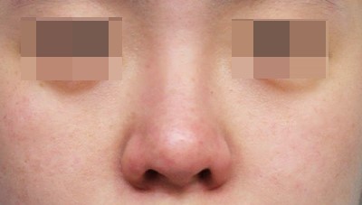 Various Nasal Tip Procedures for Bulbous Nose Correction image 1