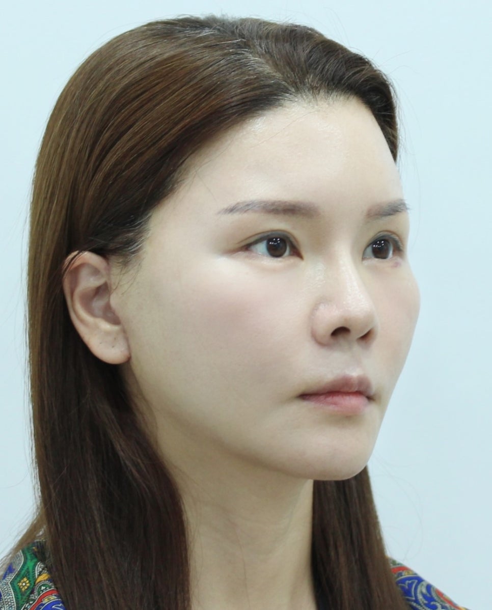 Correcting Cheek Sagging and Sunken Cheeks After Facial Contouring Surgery image 10