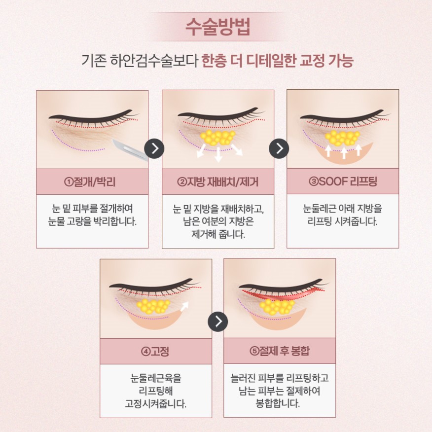 하안검 vs 눈밑지방재배치, 40~50대에서 선택하기 관련 이미지 2
