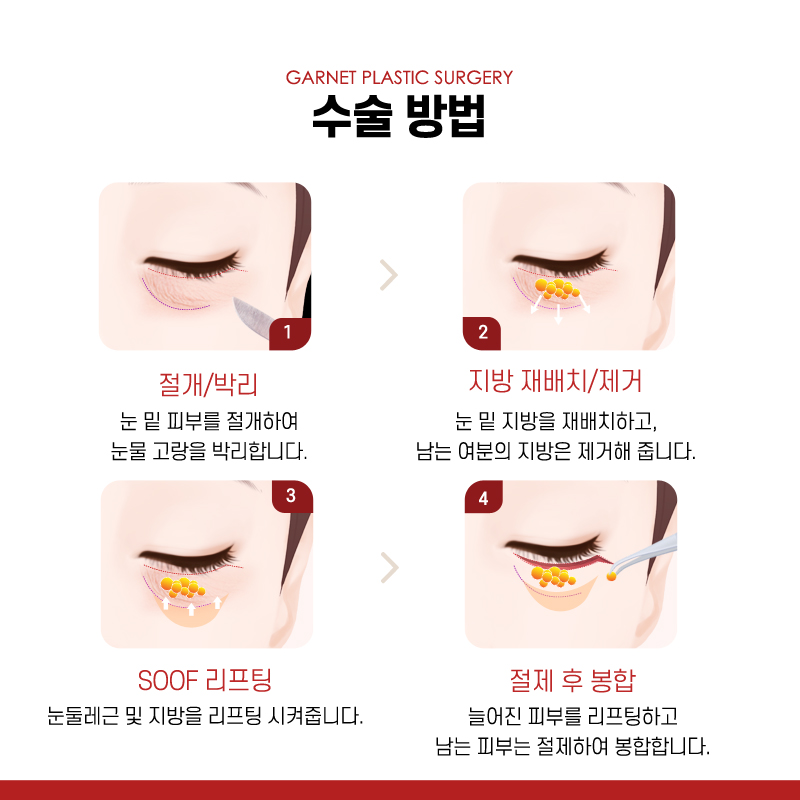 【가넷성형외과 백인수원장 성형칼럼】 60대 쿼드플러스 하안검 수술 관련 이미지 4