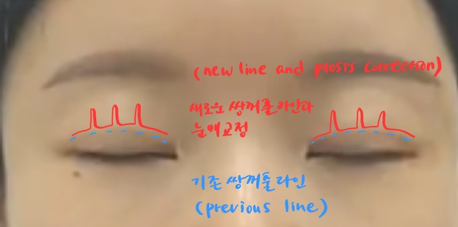 Non-incisional Eye Correction in Revision Surgery for Buried-Method Double Eyelids image 5