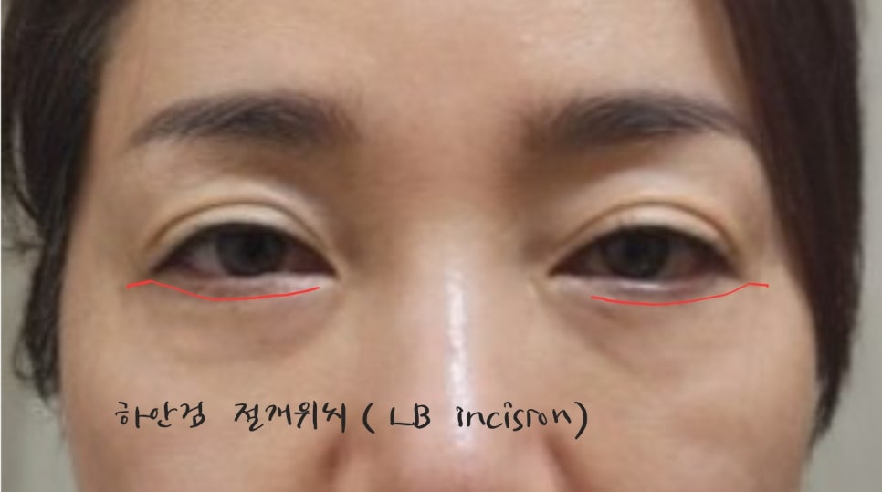 애교살을 보존하는 하안검 수술 관련 이미지 4