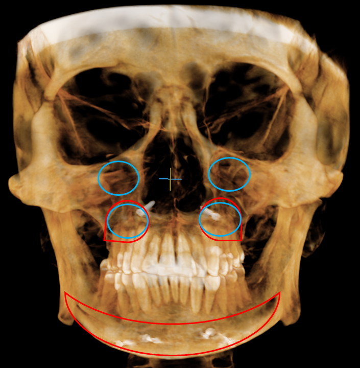 Does a Smaller Facial Skeleton Sag Faster? A Deep Mini Facelift Case in a Patient in Her 40s image 3