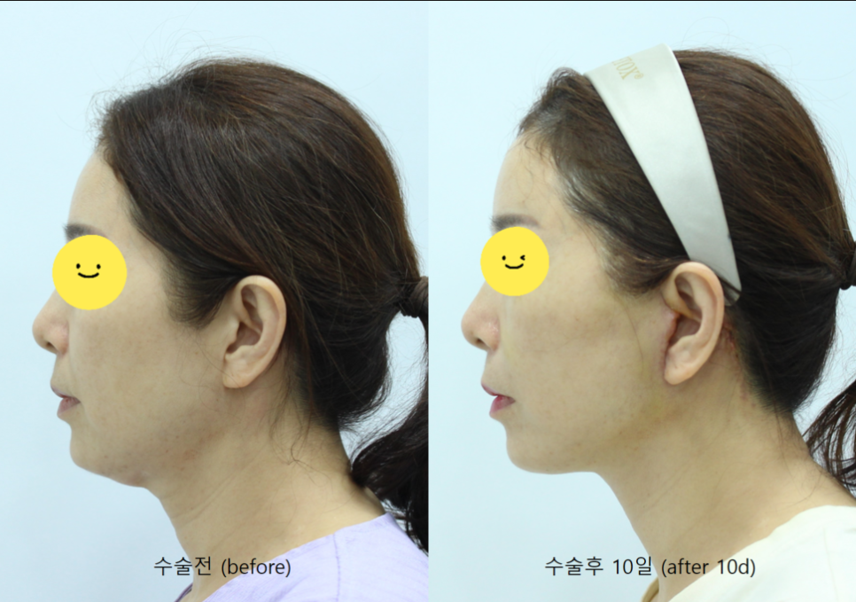 안면거상의 회복기간 관련 이미지 6
