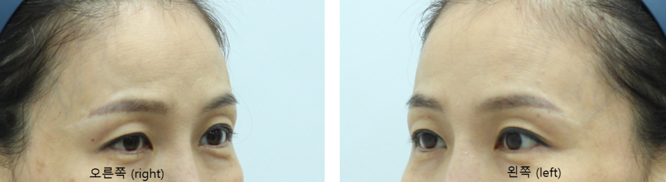 Forehead Lift to Correct Eyebrow Asymmetry image 2