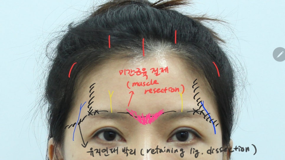 Forehead Lift After Upper Blepharoplasty image 5