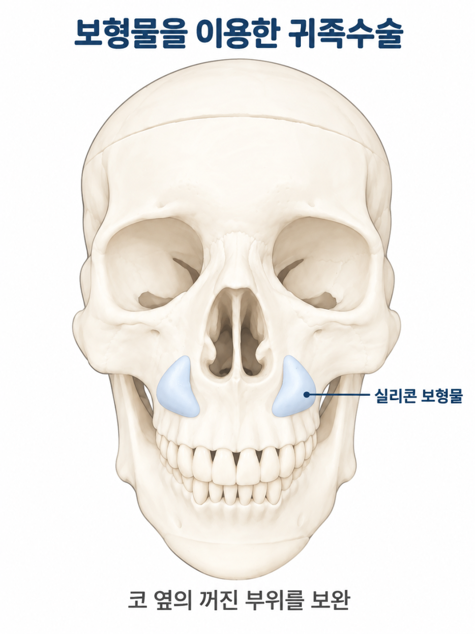 귀족수술을 했는데도 팔자주름이 남는 이유 관련 이미지 1