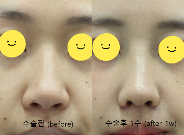 Two Methods of Nostril Reduction (Alar Reduction) image 5