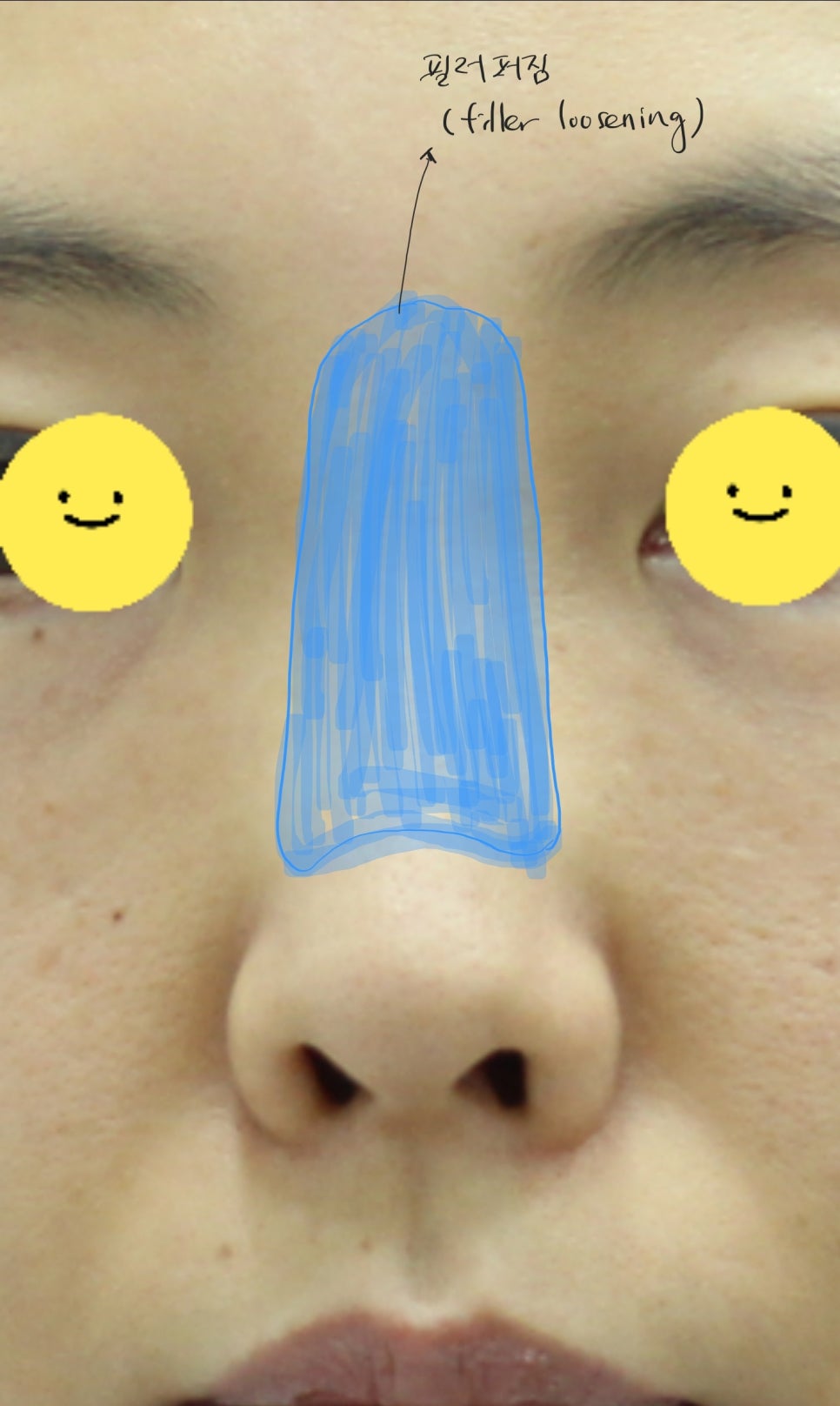 오래된 코필러를 녹이면서 시행하는 코성형 관련 이미지 4