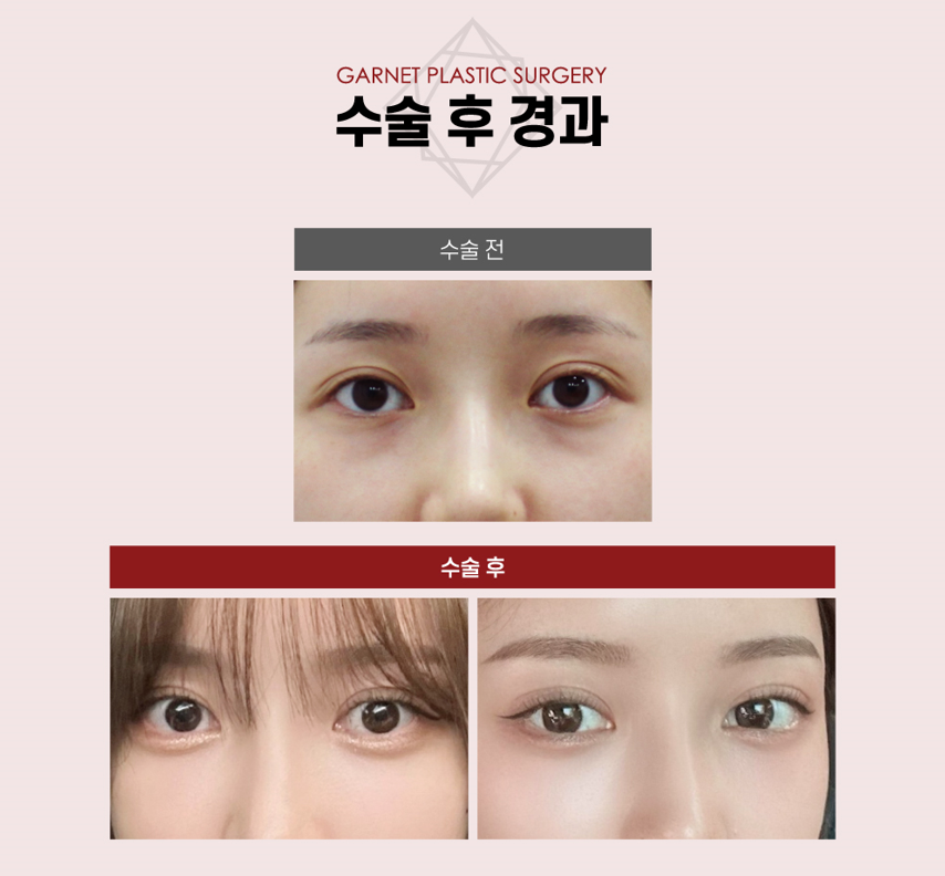 【가넷성형외과 백인수원장 성형칼럼】 애교필러 VS 눈밑 미세지방이식 관련 이미지 6
