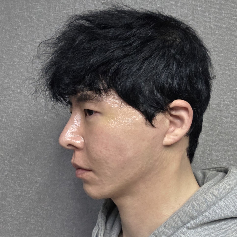 남자 안면거상, 구렛나루를 지키는 것이 중요한 이유 관련 이미지 6