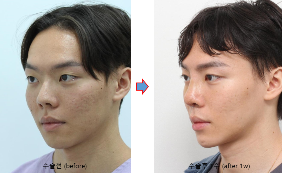 코뼈를 깎지 않는 코성형? 3D CT 맞춤형 코보형물 관련 이미지 4