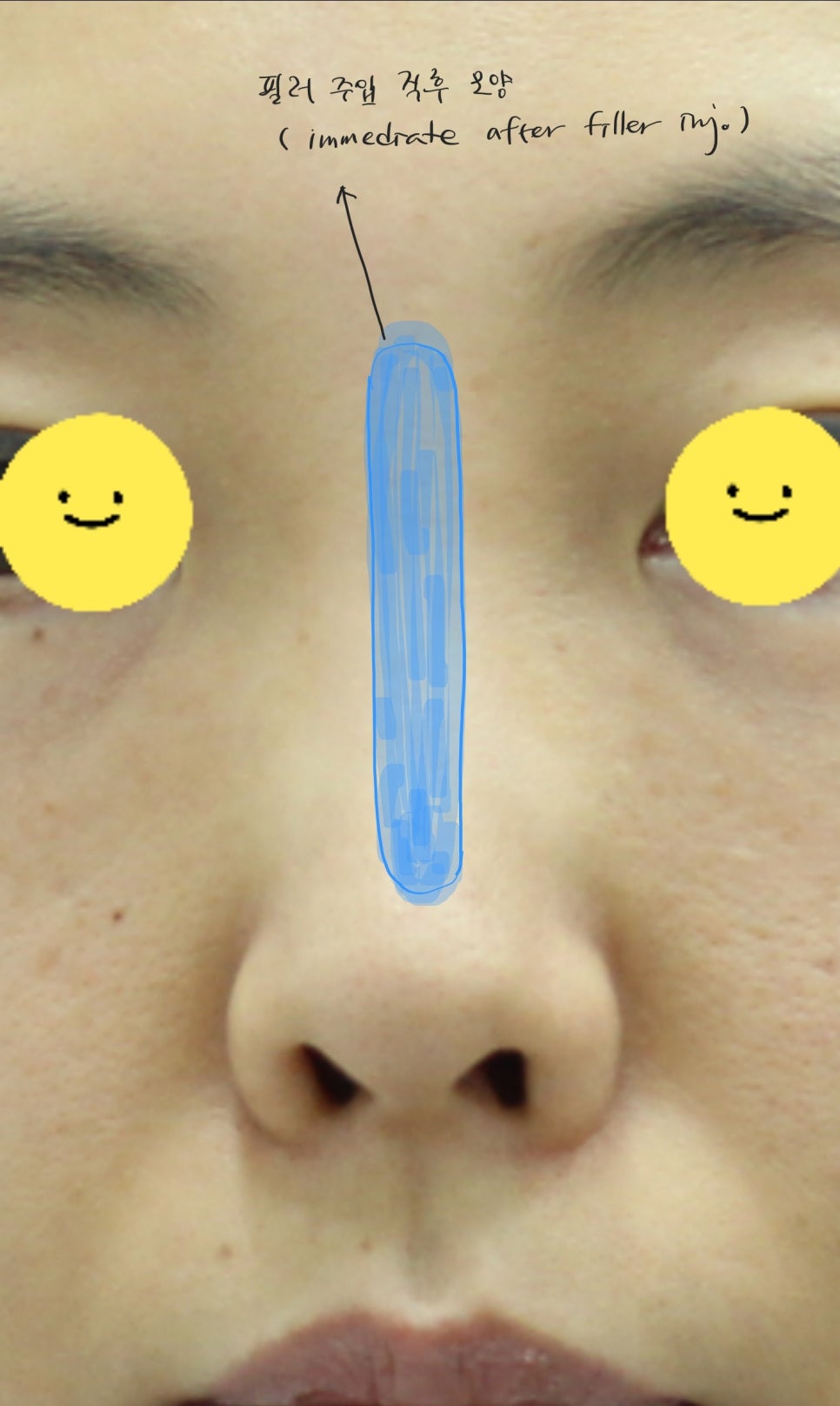 오래된 코필러를 녹이면서 시행하는 코성형 관련 이미지 1