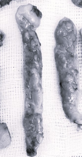 Nasal Tip Skin Irritation Caused by L-Shaped Silicone image 4