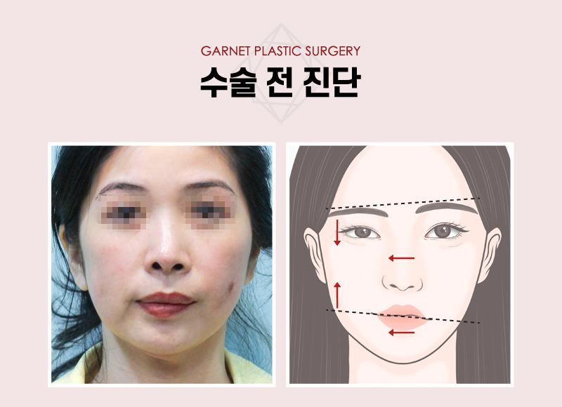 【Garnet Plastic Surgery Director Baek In-soo’s Plastic Surgery Column】 Facial Asymmetry and Crooked Nose Surgery image 3