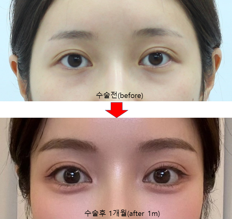 눈 아래부분을 화려하게 만드는 눈성형 관련 이미지 5