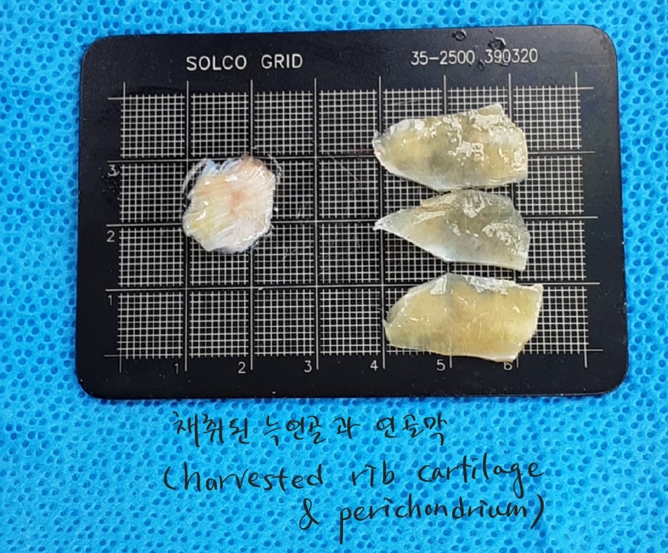 늑연골을 이용한 비주함몰의 교정 관련 이미지 6