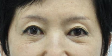 눈밑 수술을 하지 않았는데, 눈밑이 좋아졌습니다 관련 이미지 1