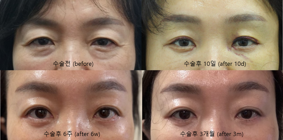 Why Horizontal Nasal Bridge Wrinkles and Eyelid Ptosis Occur Together, and the Role of Brow Lift Surgery image 6
