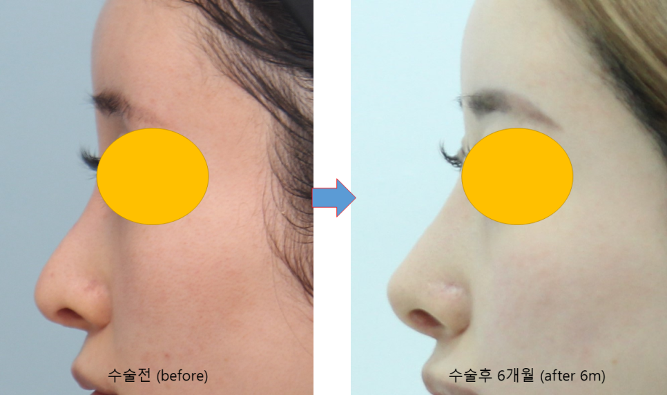 Consultation Process and Surgical Items for Revision Rhinoplasty image 10