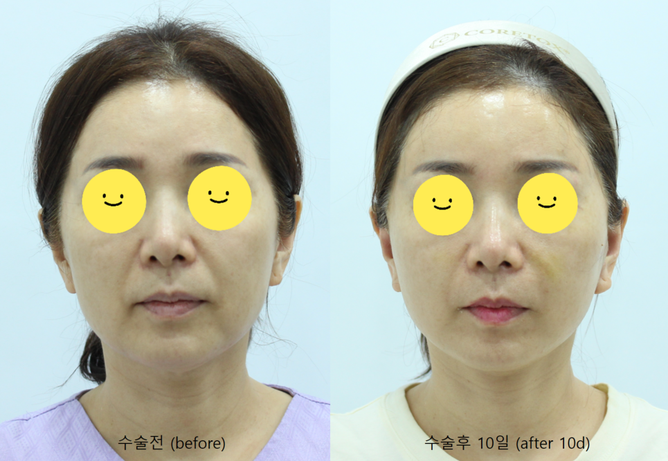 안면거상의 회복기간 관련 이미지 5