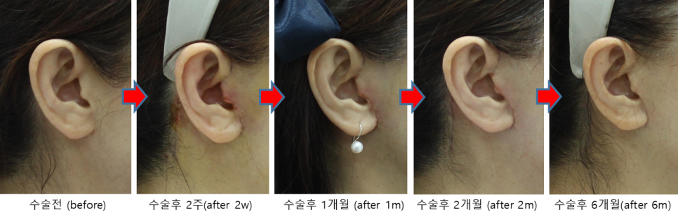 안면거상, 긴 절개선인데 흉터가 눈에 잘 띄지 않는 이유 관련 이미지 5