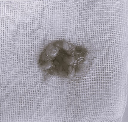 Sagging Skin After Facial Contouring Surgery (Cheek Sagging) image 7