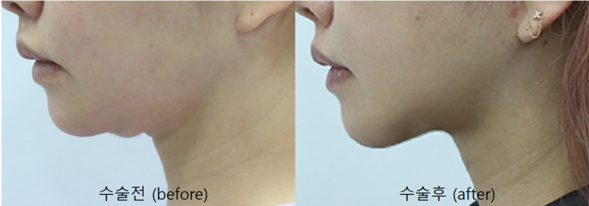 Submental Incision Neck Lift for a Deep Neck Line image 6