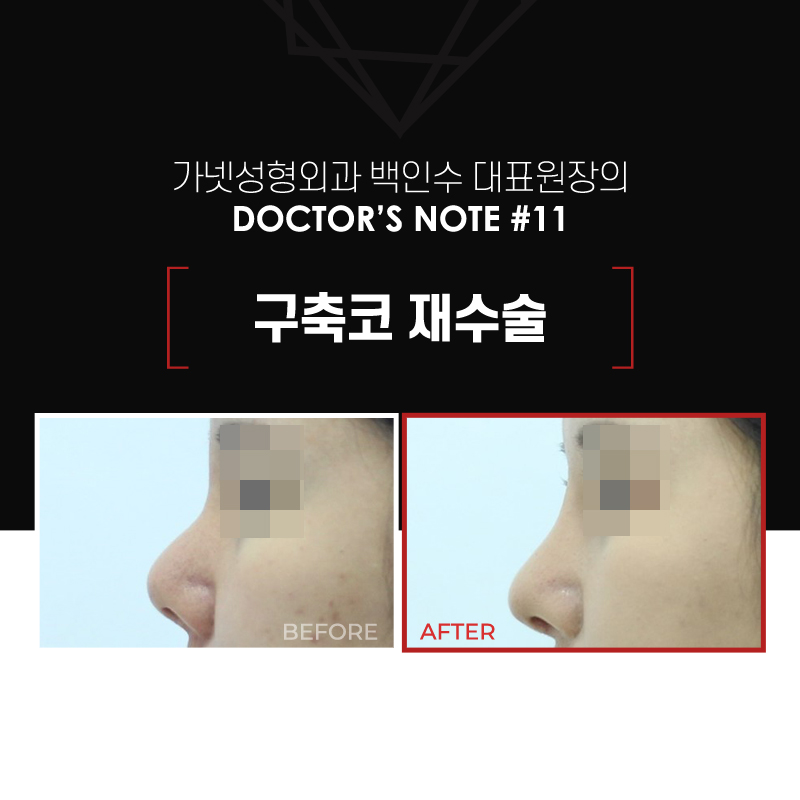 【Garnet Plastic Surgery Director Baek Insoo’s Plastic Surgery Column】 Rib Cartilage Contracted Nose Revision Surgery (Removal of Nose Implant) image 2