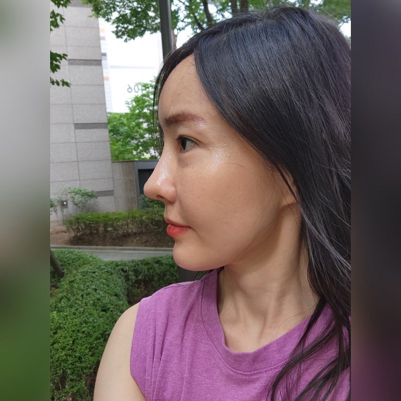 코끝떨어짐 늑연골 재수술 관련 이미지 9