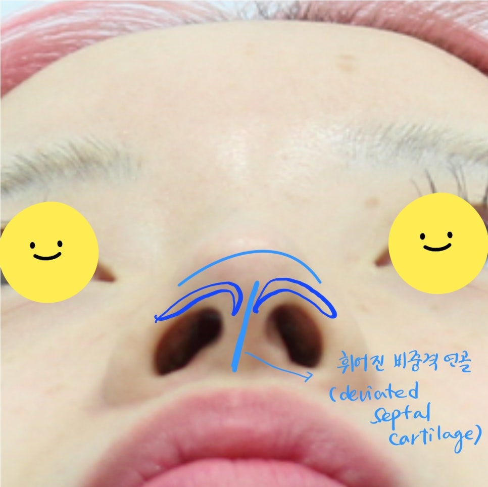 코성형후에 코가 휘었을때의 재수술 관련 이미지 8