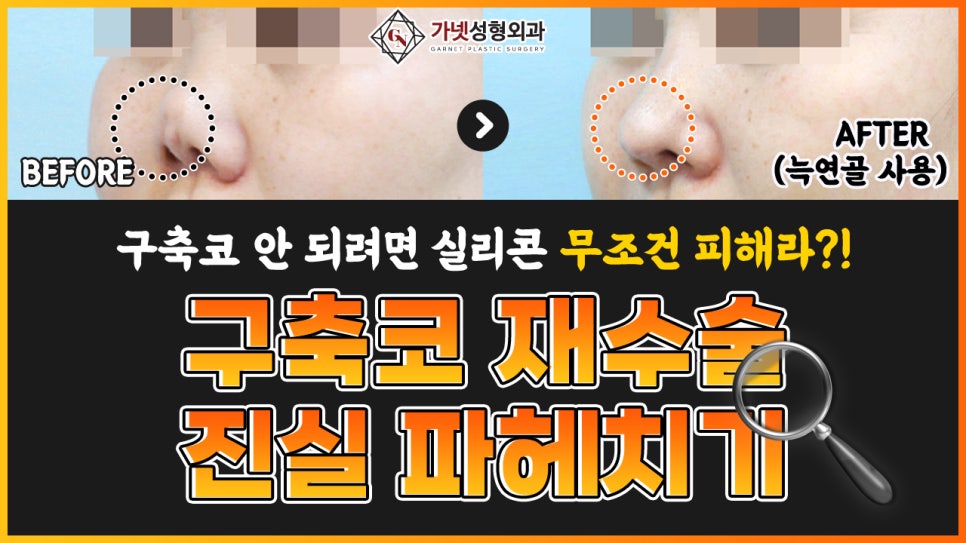Let’s Learn Everything About Contracted Nose Revision Surgery at Garnet Plastic Surgery in Apgujeong image 1