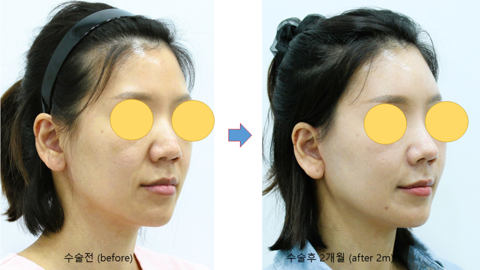 Areas of the Face Improved by a Deep Mini Facelift image 7