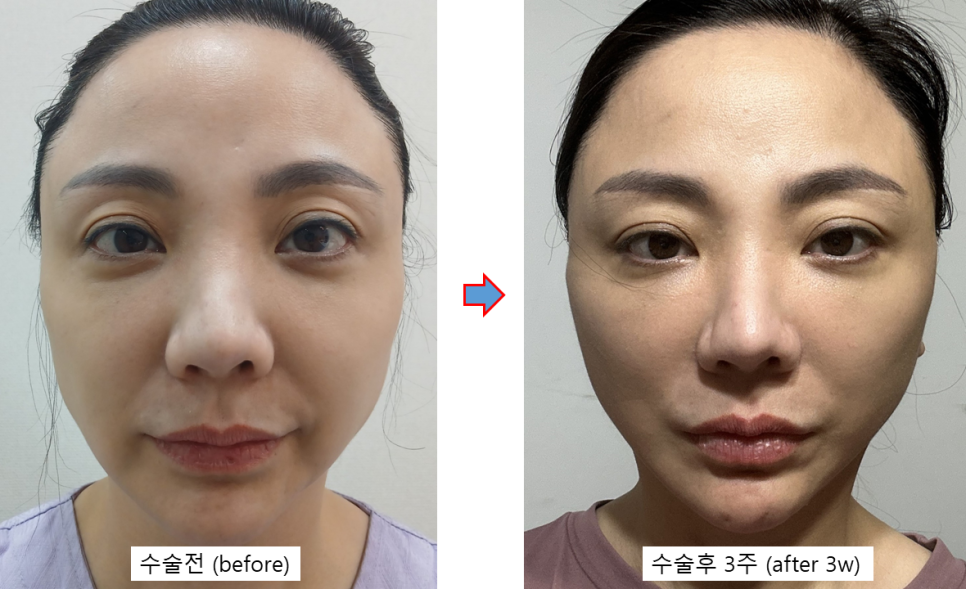 Does a Smaller Facial Skeleton Sag Faster? A Deep Mini Facelift Case in a Patient in Her 40s image 4
