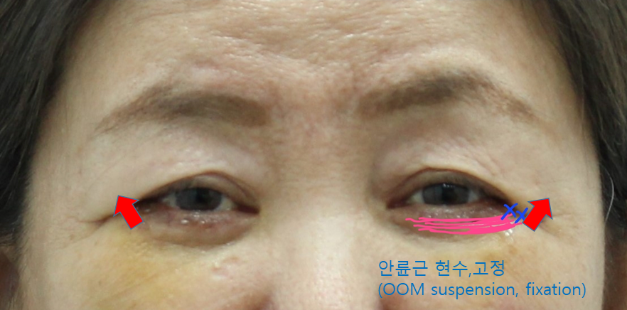 안검외반의 위험성을 예측하고 예방하는 하안검 관련 이미지 3