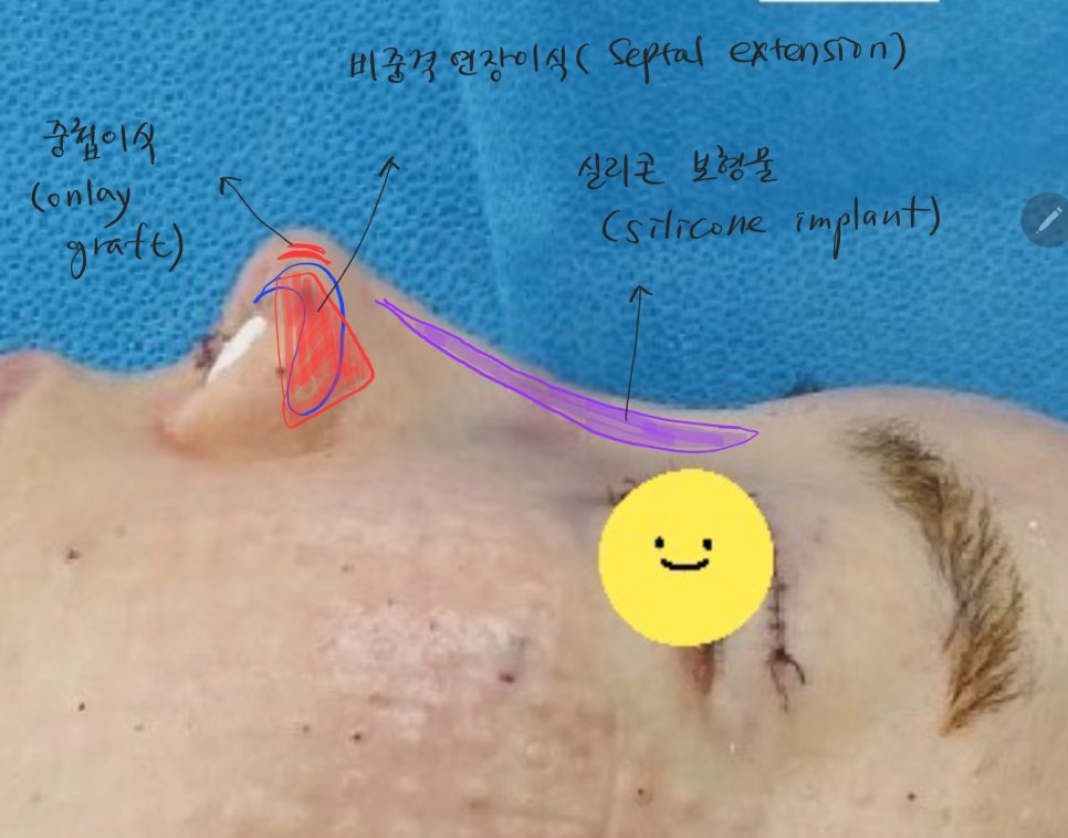 오래된 코필러를 녹이면서 시행하는 코성형 관련 이미지 9