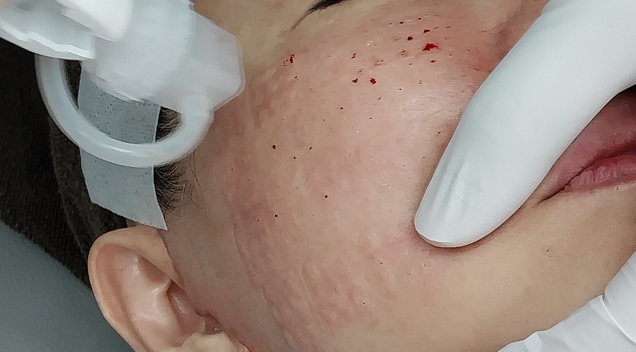 피부장벽을 통과하는 적절한 스킨부스터 시술 관련 이미지 6