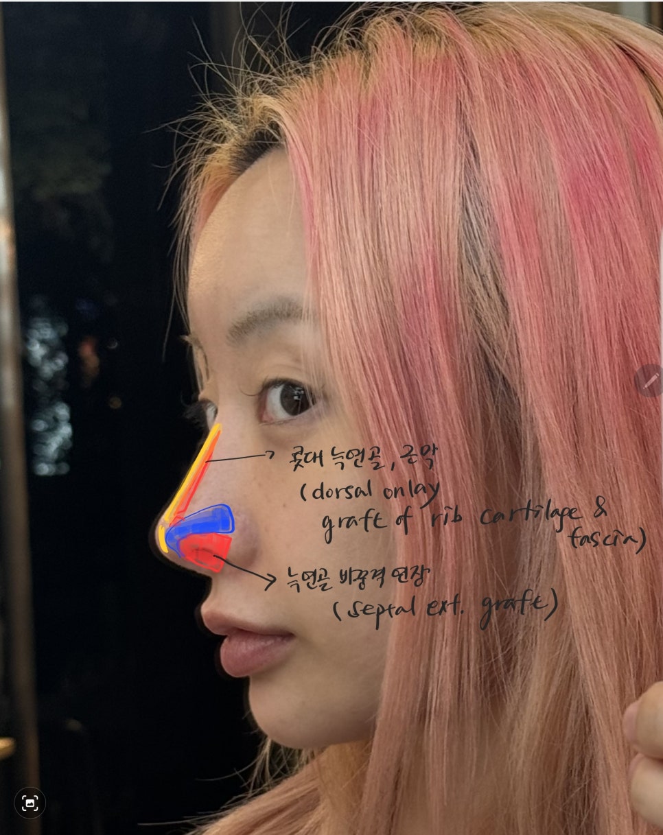 Rhinoplasty for Zainichi Koreans, Rhinoplasty for Japanese Koreans image 6