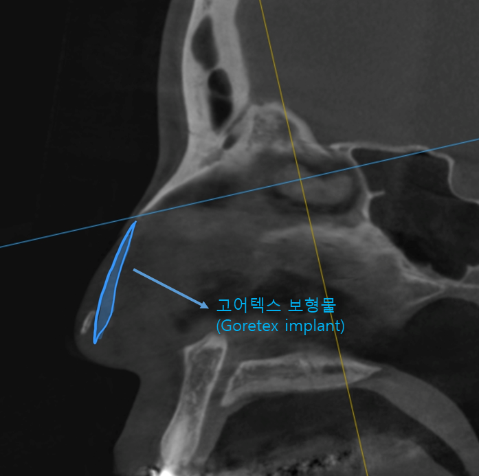 고어텍스 보형물을 자가조직으로 교체하는 코성형 관련 이미지 2