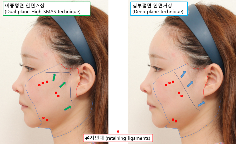 안면거상, 긴 절개선인데 흉터가 눈에 잘 띄지 않는 이유 관련 이미지 2